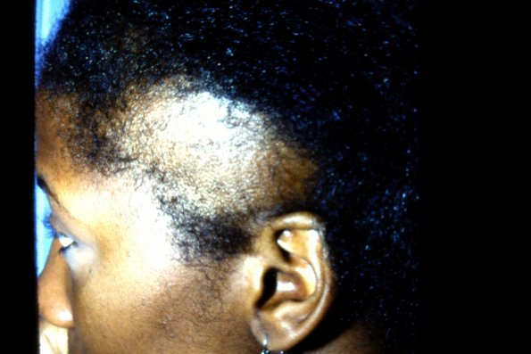 Traction Alopecia Vs. Trichotillomania