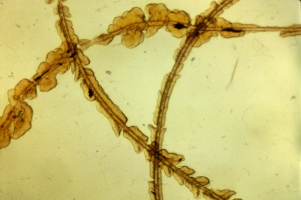 Trichomycosis Axillaris (2)