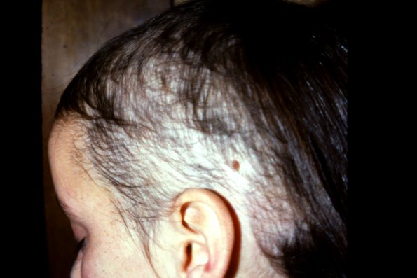 Trichotillomania (11)