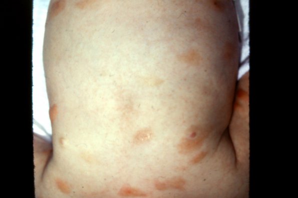 Urticaria Pigmentosa (13)