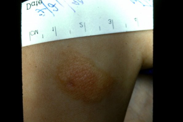 Urticaria Pigmentosa (2)