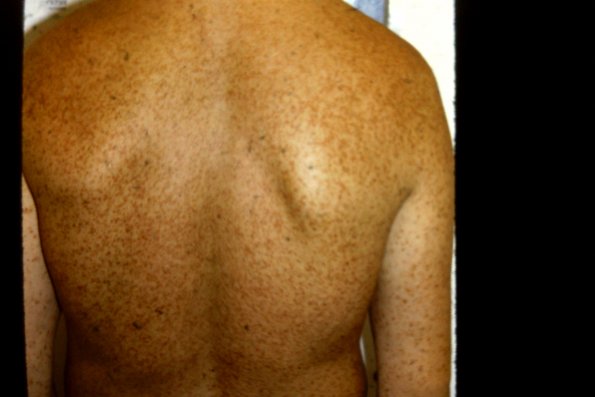 Urticaria Pigmentosa (22)