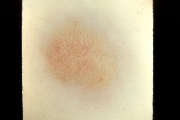 Urticaria Pigmentosa (5)