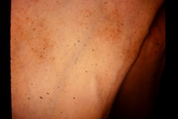 Papular Urticaria (7)