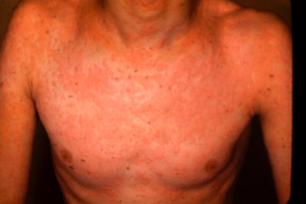 Urticaria (4)