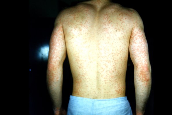 Urticaria