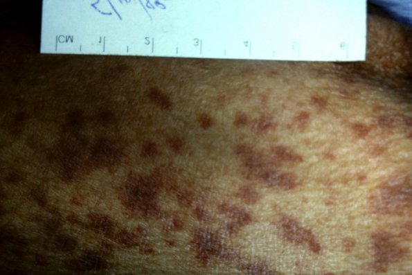 Leukocytoclastic Vasculitis Palpable Purpuric L.P. like Vasculitis