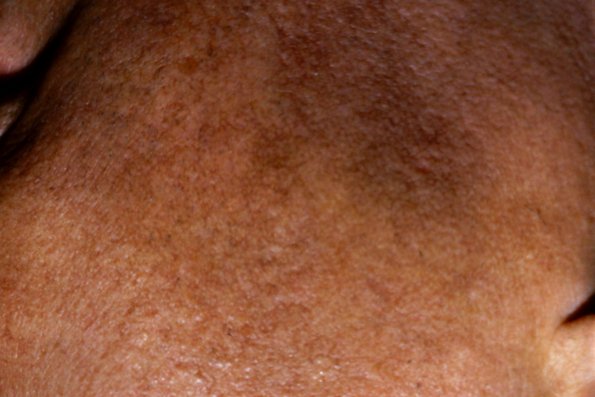 Erythema Dyschromium Perstains