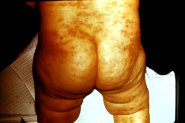 Erythema Jacquet (2)