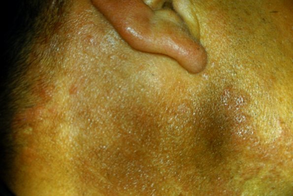 Erythema Perstans (6)