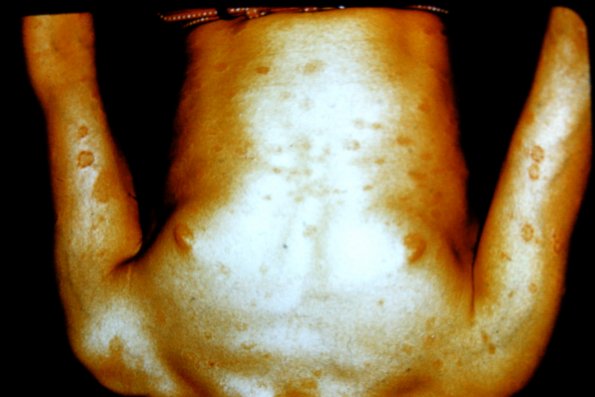 Pityriasis Rosea (5)