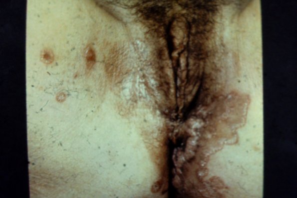 Secondary Syphilis (23)