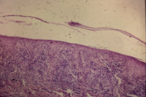 Secondary Syphilis (27)