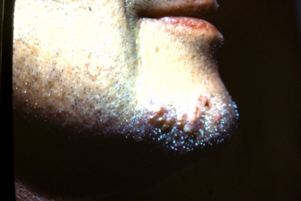 Tinea Barbae