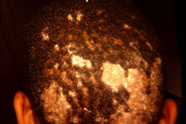 Tinea Capitis