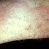 Tinea Corporis (12)