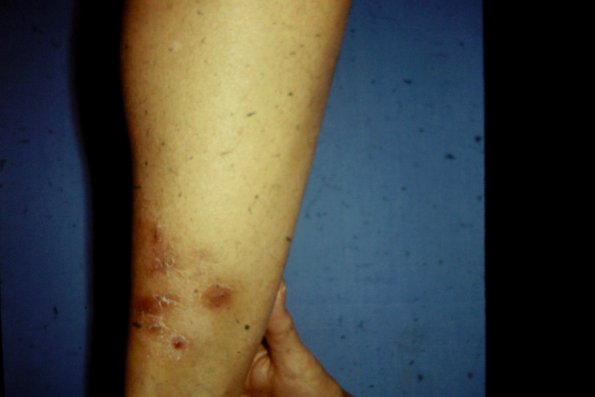 Tinea Corporis (13)