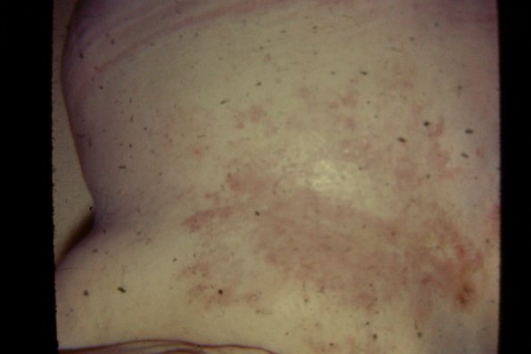 Tinea Corporis (16)