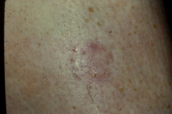 Tinea Corporis (2)