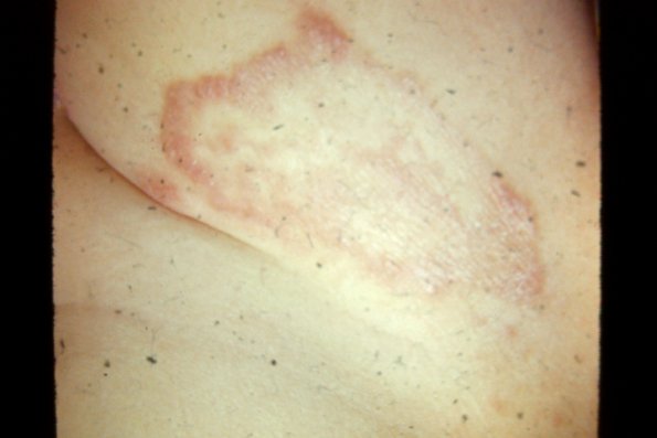 Tinea Corporis (21)