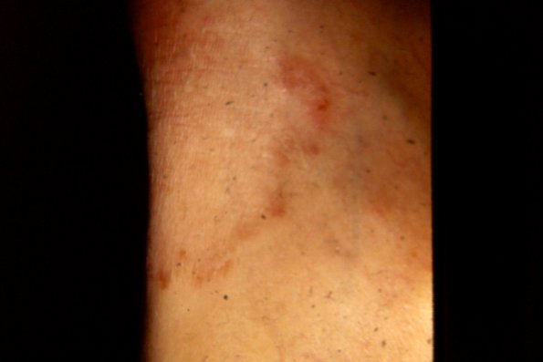 Tinea Corporis (23)