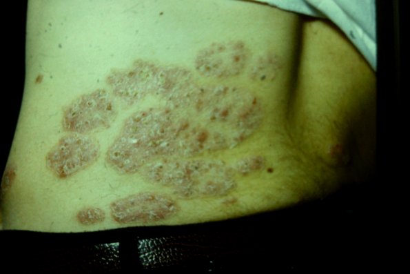 Tinea Corporis (3)