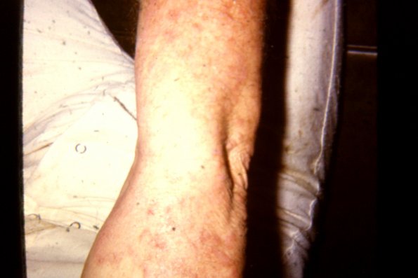 Tinea Corporis (30)