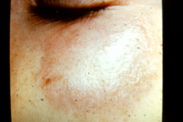 Tinea Corporis (31)