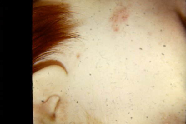 Tinea Corporis (32)