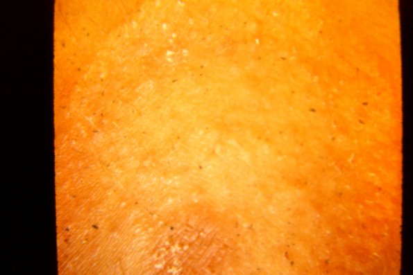 Tinea Corporis (33)