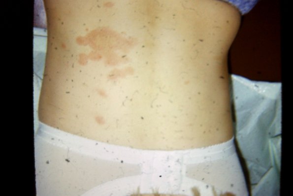 Tinea Corporis (34)