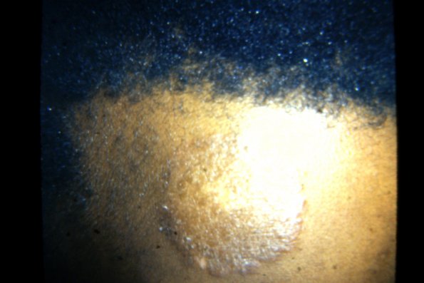 Tinea Corporis (37)