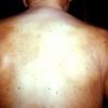 Tinea Corporis (38)