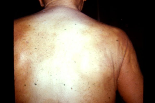 Tinea Corporis (38)