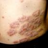 Tinea Corporis (7)