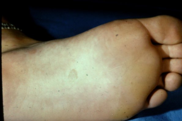 Tinea Nigra Plantaris (2)