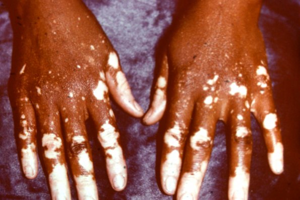 Vitiligo (2)