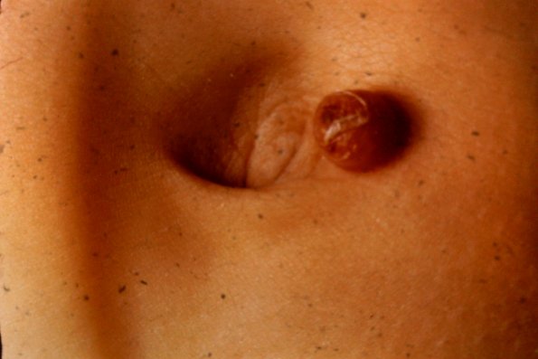 Juvenile Xanthogranuloma (7)