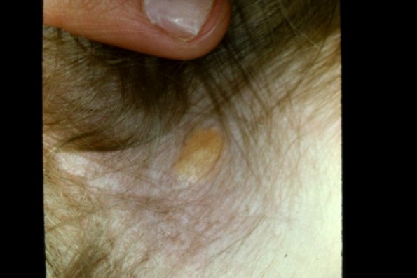 Xanthogranuloma