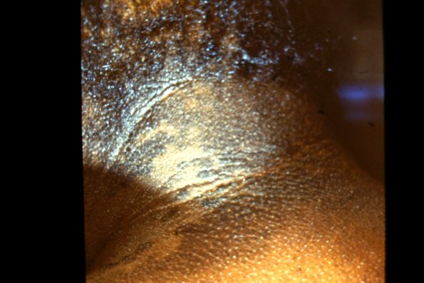 Psuedo Acanthosis Nigricans (3)