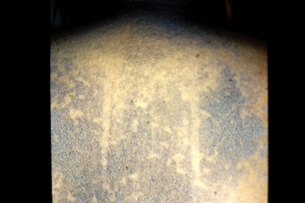 Psuedo Acanthosis Nigricans (4)