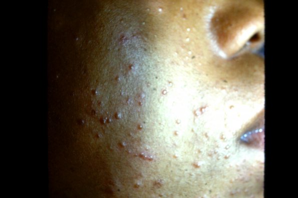 Steroid Acne (2)