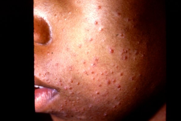 Steroid Acne