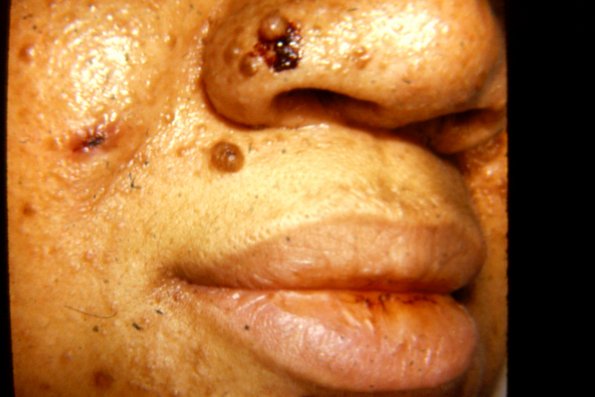 Adenoma Sebaceum (14)