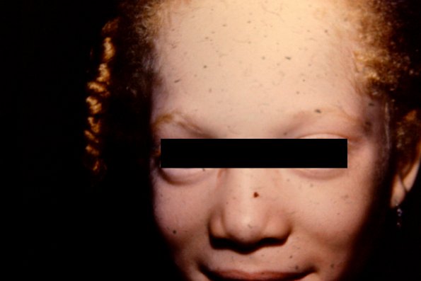 Albinism (2)