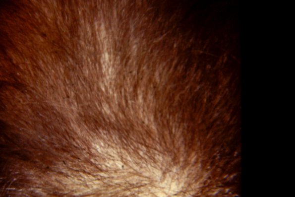Alopecia Areata (11)