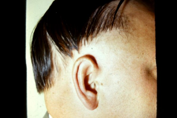 Alopecia Areata (3)