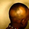 Alopecia Areata (5)