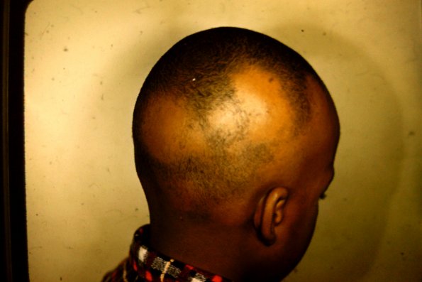 Alopecia Areata (5)
