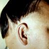 Alopecia Areata (6)